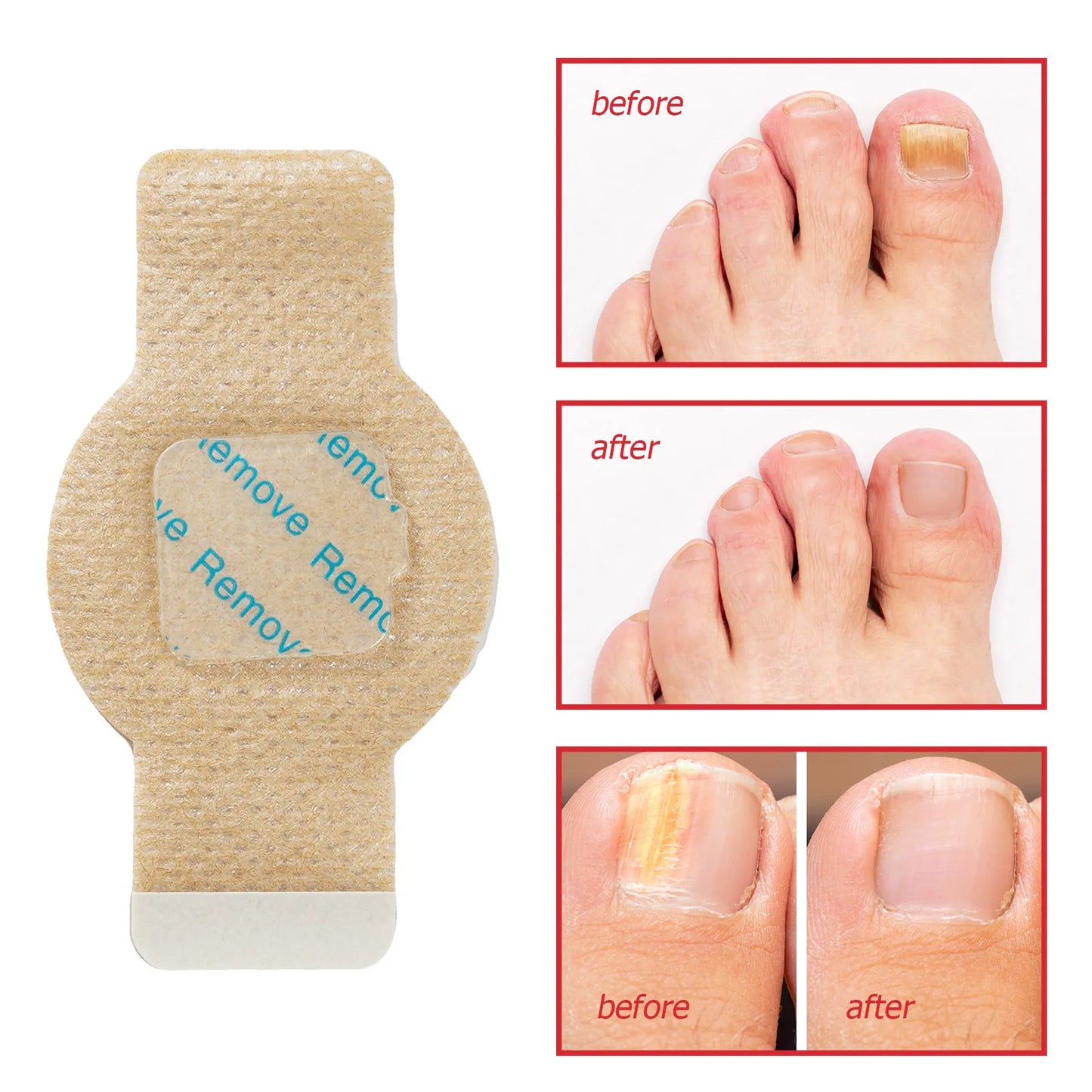 Fungal Nail Patches! (50% OFF Today)