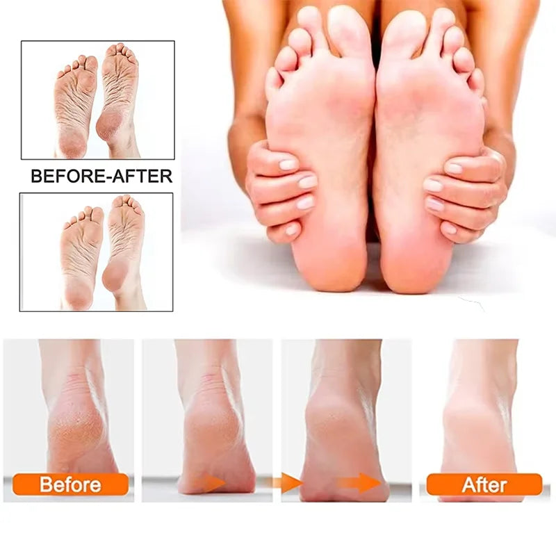 Electric Foot Callus Remover (50% OFF Today!)